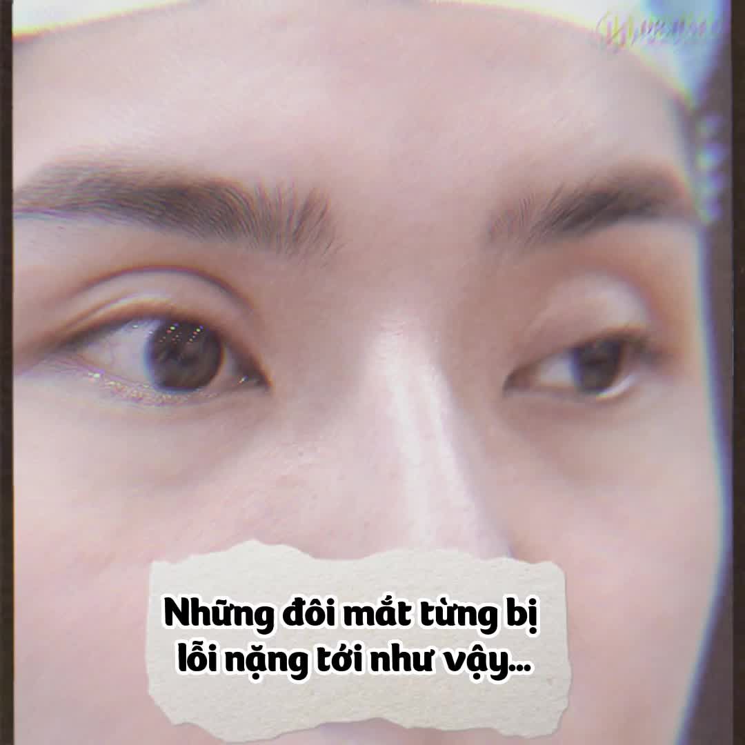 Đã từng có những nếp mí lỗi hỏng tới như vậy....